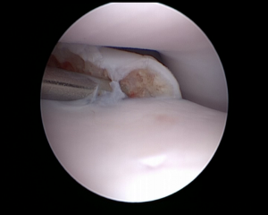 Arthroscopie du coude d'un chien - Dysplasie du coude - Processus coronoide