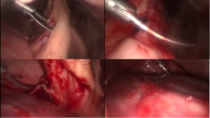 Péricardectomie sous thoracoscopie chez un chien - Thoracoscopie et chirurgie vétérinaire